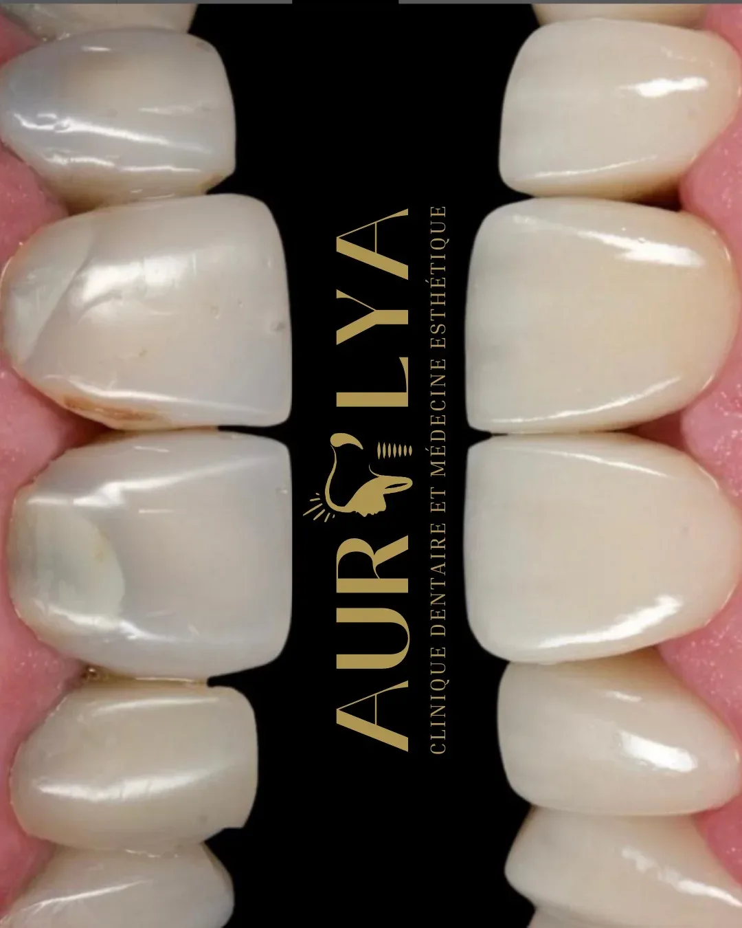 Dentisterie-esthétique-facettes dentaires