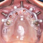 Implants dentaires guidés