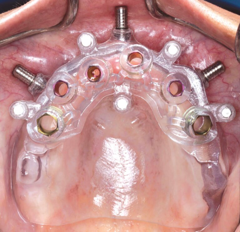 Guided Dental Implants
